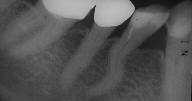 Racine en S – risques relevant d’un défi majeur en endodontie