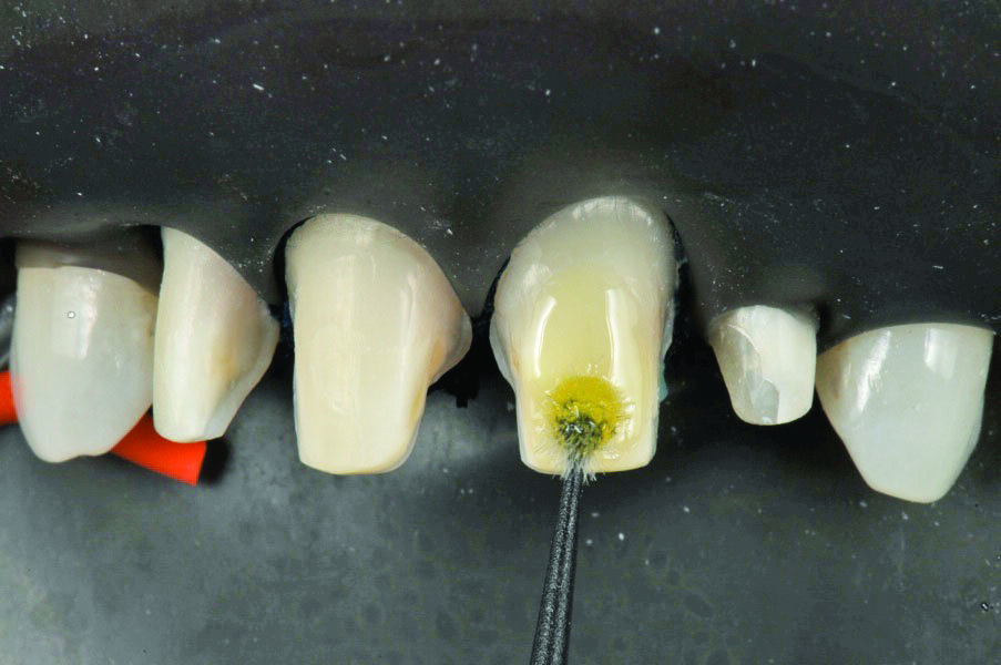 Fig. 17: Apply 3M™ Single Bond Universal Adhesive and rub it in for 20 seconds.