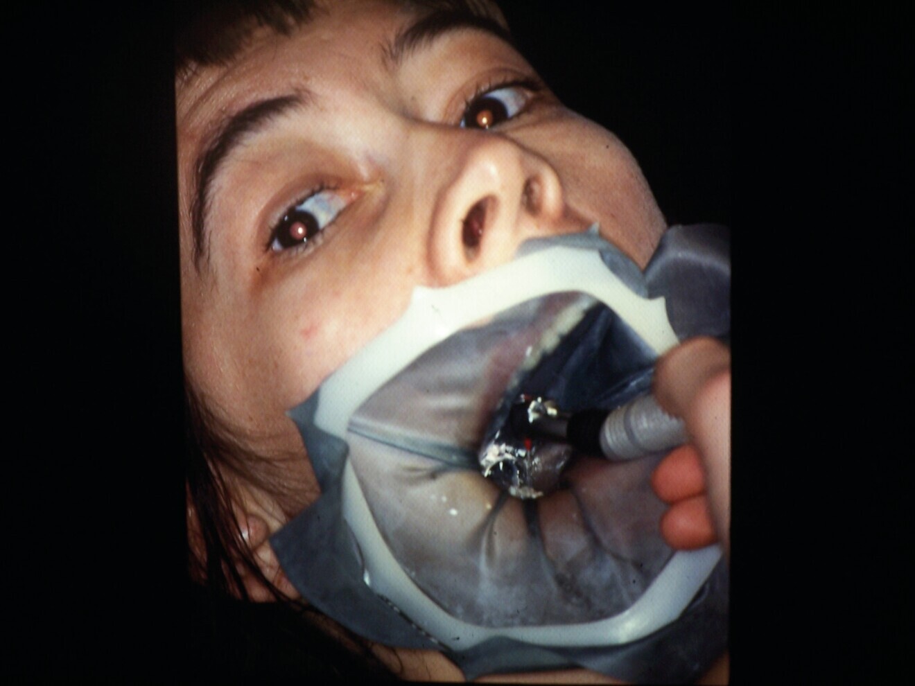 Fig. 3 : Cadre fermé. Cadre NYGAARD. 