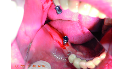 The indispensable use of CBCT in the posterior mandible