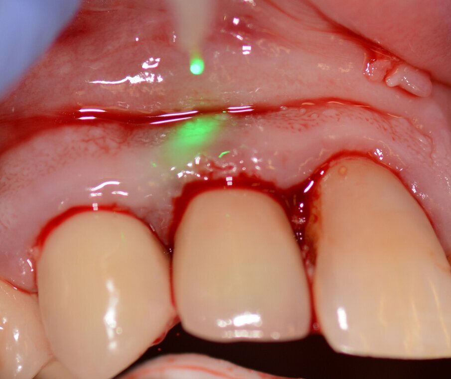 Fig. 6: Photo-biomodulation with the Nd:YAG laser.