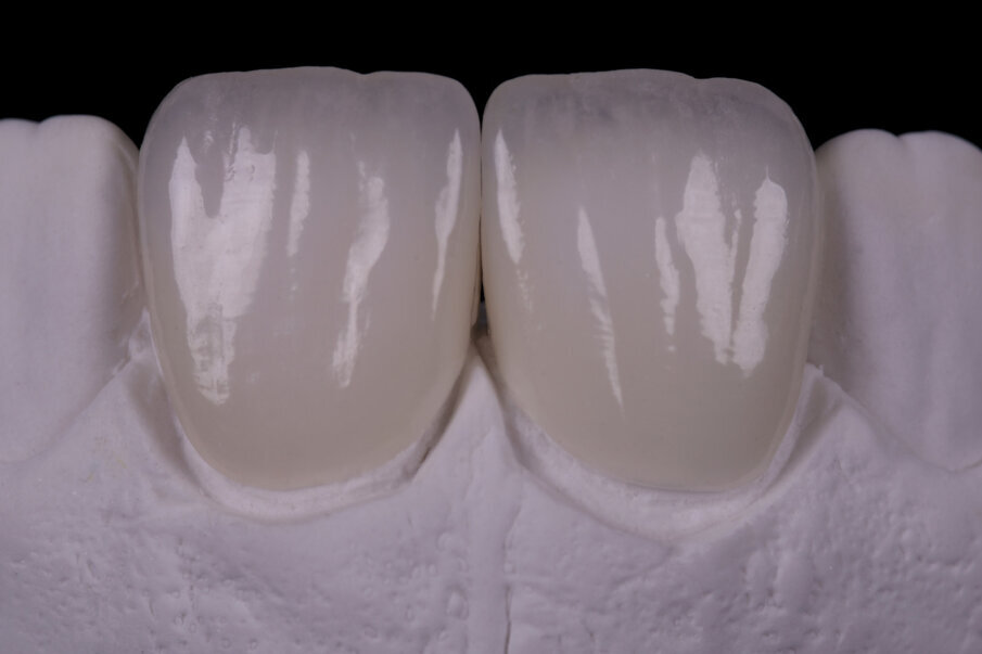 Fig. 29: Ceramic restoration finished with manual external texture creation procedures.
