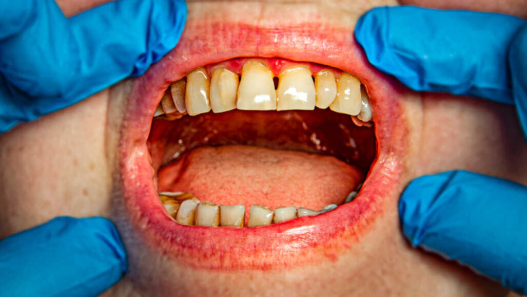 La parodontite può raddoppiare le probabilità di declino cognitivo