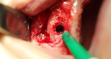Augmentacja kości szczękowych z zastosowaniem kości ludzkiej świeżo mrożonej