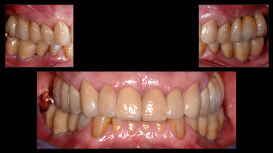 Obr. 17a–c: Klinické a radiologické vyšetření při kontrole po pěti letech. (Fotografi e P. Zappavigna DDS)