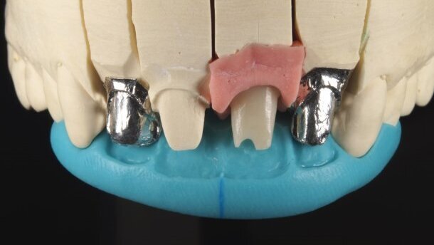 Złożona technika ceramiki i łącznik hybrydowy Ti/Zr w rozwiązaniu trudnego przypadku estetycznego