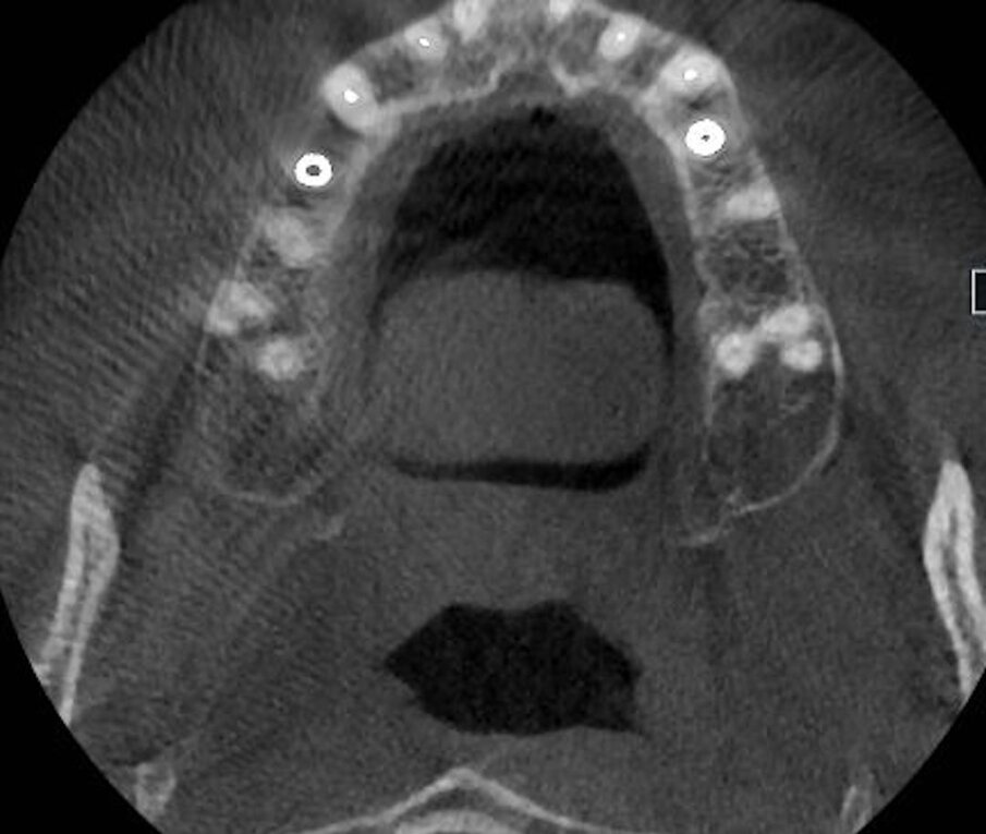 Fig. 6b, 6c - Le sezioni alla Cone beam mostrano il mantenimento volumetrico dell’osso alveolare.