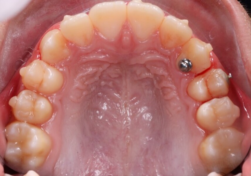 Figs. 6a–e: Intra-oral photographs after the first phase of treatment.