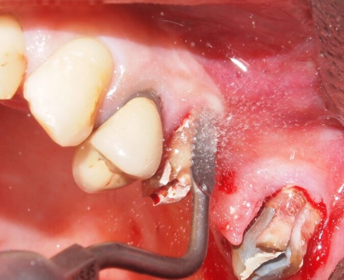 Fig. 5 - Inserto tipo MICRO-SAW. Può essere utilizzato, a seconda dei paramentri di potenza impostati, per sindesmotomia, osteotomia, osteoplastica, prelievi ossei,estrazioni chirurgiche, split-crest, odontotomie.