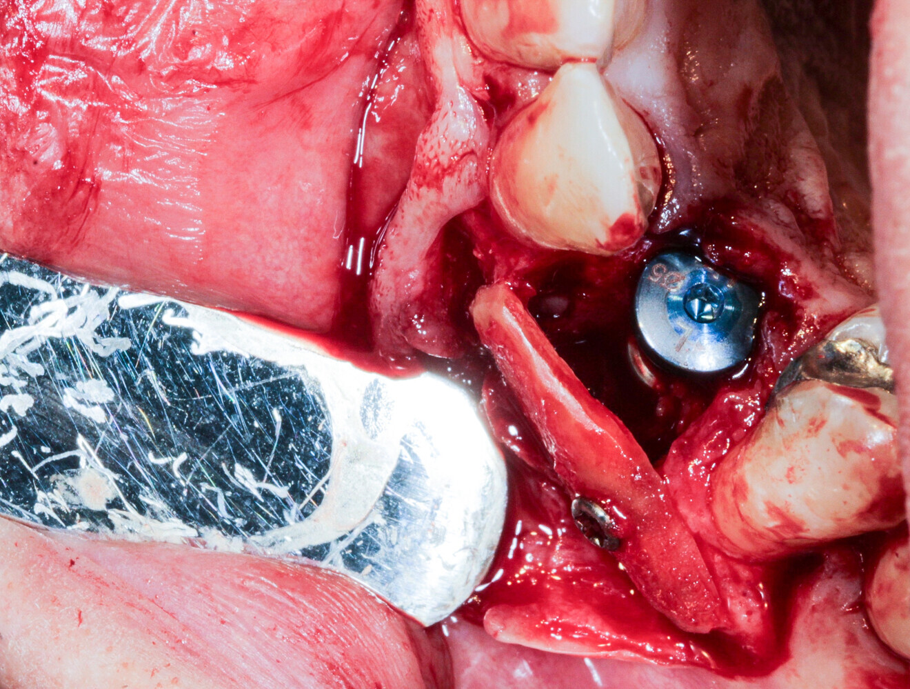 Fig. 16: Preparation of the root and fixation with an osteosynthesis screw to replace the lost wall.
