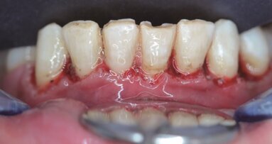 Interdyscyplinarne podejście do stosowania lasera Er,Cr:YSGG – leczenie estetyczne tkanek twardych i miękkich