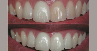 Sobre el blanqueamiento dental