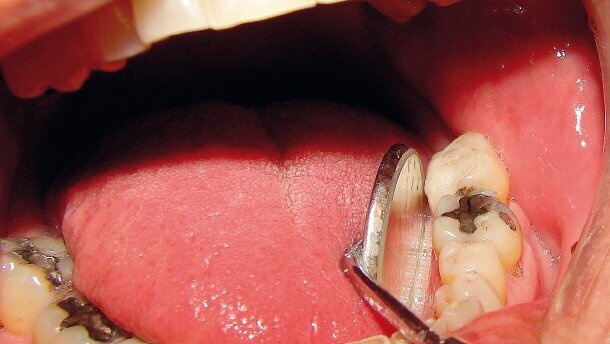 “La medicina e l’odontoiatria biologica fra tradizione ed innovazione: uso dei metalli pesanti, aspetti clinici e legali”