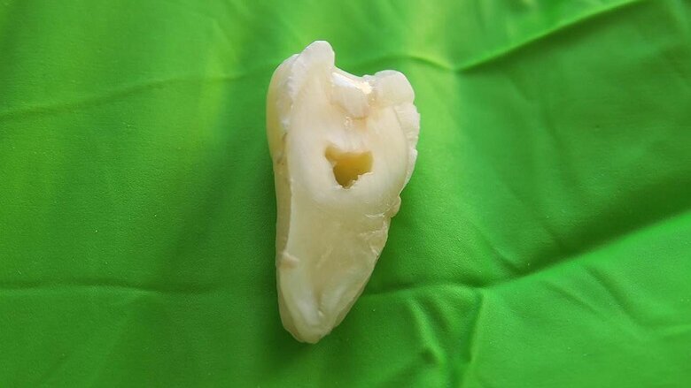 New dental reconstruction material offers improvements over acrylate-based fillers