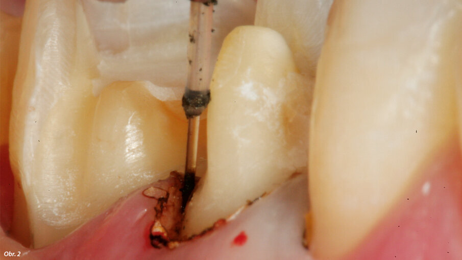 Pro uvolnění prostoru v měkkých tkáních kolem obvodu preparace za účelem úplného přesného skenu okrajů preparace možno provést žlábkování diodovým laserem (Gemini, Ultradent Products).