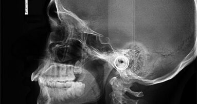 Widening the scope of aligner application: A case report