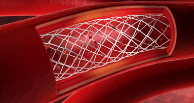 Parodontitis begünstigt Arterienverkalkung
