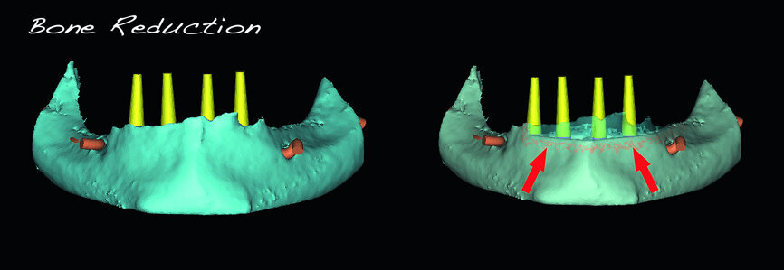 Fig. 8: The need for bone reduction to flatten the ridge for implant placement (red arrows).