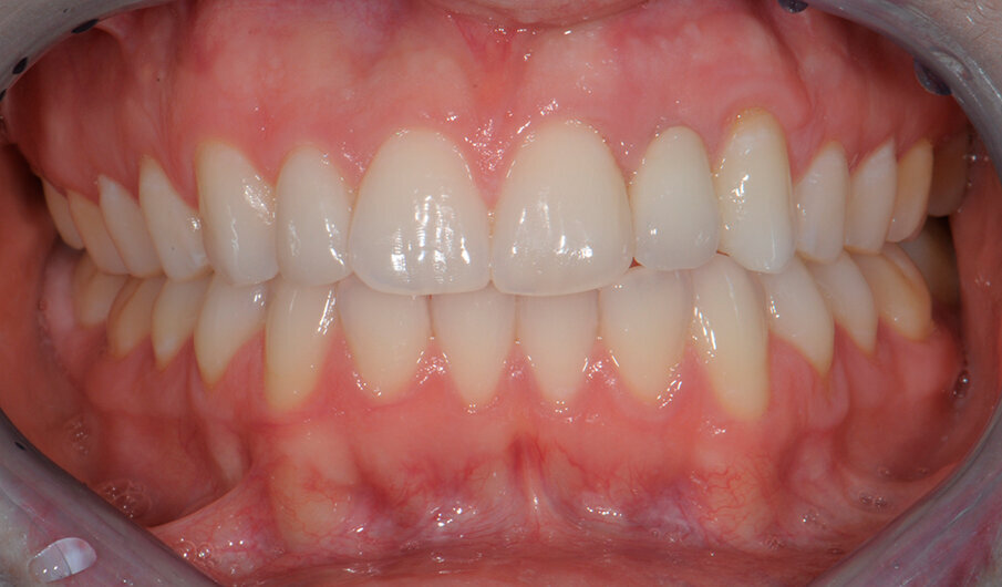 Fig. 8b - Occlusione finale della paziente.