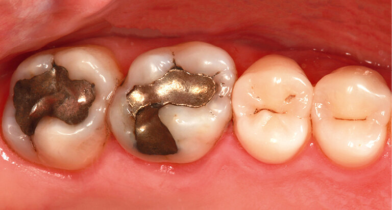 Fig. 12: Two insufficient amalgam fillings needing to be replaced