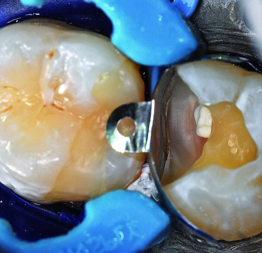 Fig. 17: Palodent V3 matrix system assemblage.
