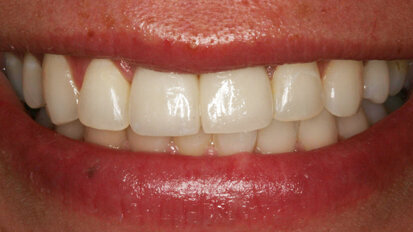 Management of two implants in the esthetic zone