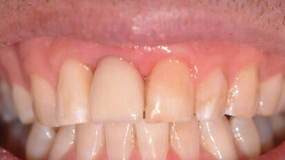 “One miracle at a time” – an implant case report