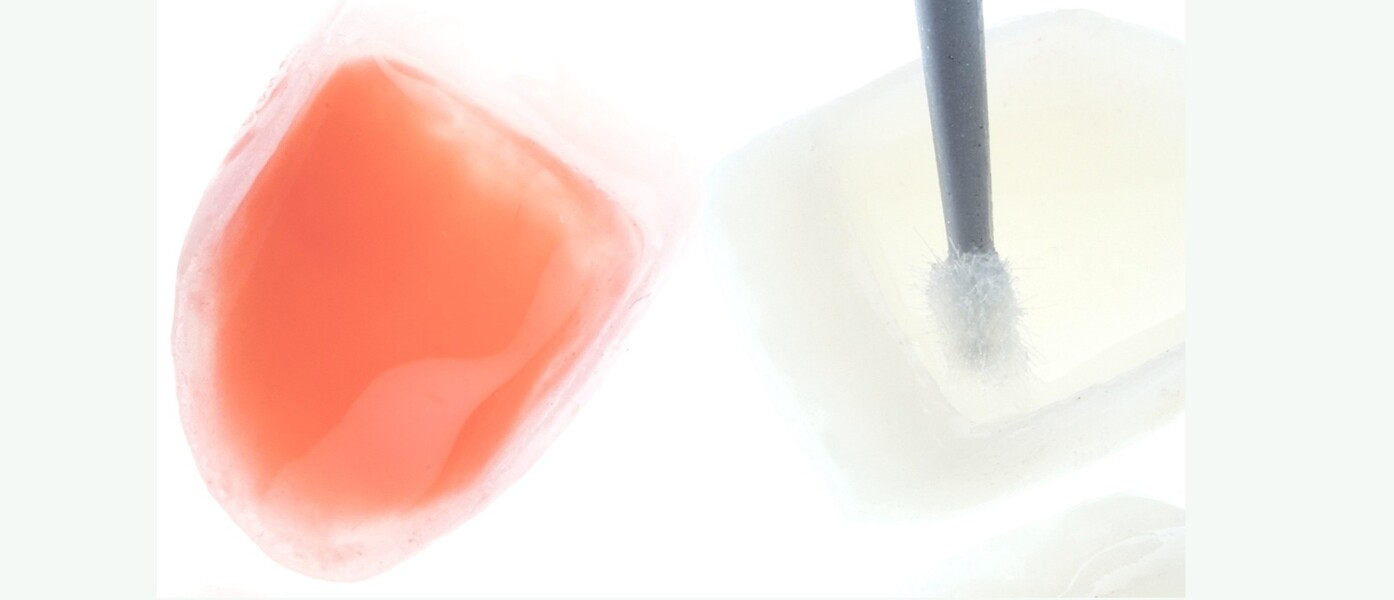 Fig. 18: Conditioning of the intaglio surface of the veneer prior to cementation.