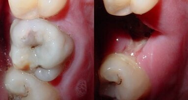 Nieuw mondwater voorkomt tandbederf