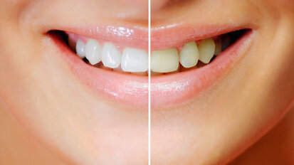 Le blanchiment ou l’éclaircissement des dents est désormais strictement réservé aux chirurgiens-dentistes