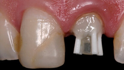 Anatomical pin: A clinical case report