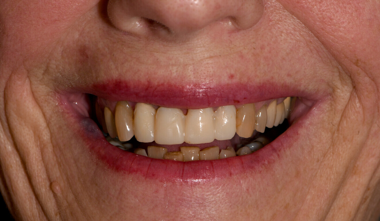 Fig. 4: Chairside-produced temporary bridge in the patient’s mouth.