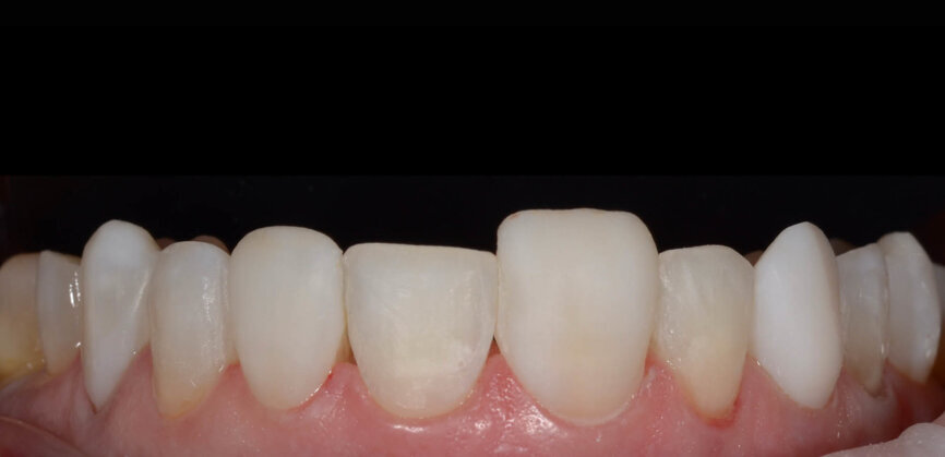 Fig. 11: Situation directly after the first round of injections. 