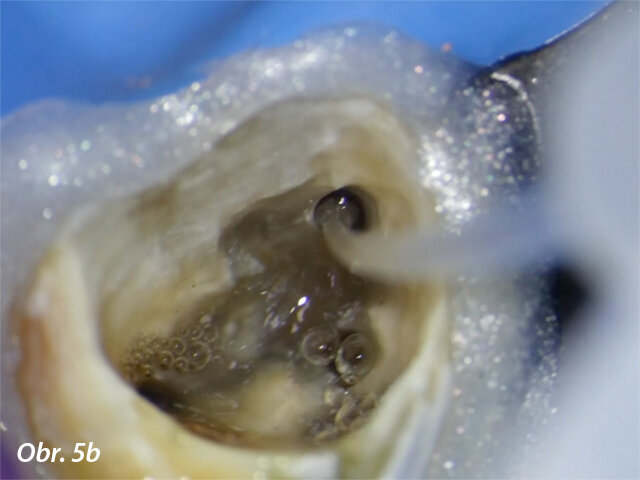 Flexibilní konec vylepšuje ergonomii výplachu a umožňuje oplach kanálkového systému u zubů se složitou anatomií