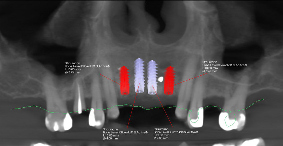 Fig. 9: Implant planning for all four positions.