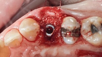Studio Carosi-Lorenzi: nuove evidenze sulla stabilità degli impianti TLX Straumann nel primo anno di guarigione