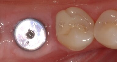 Αποζημίωση μαμούθ για λάθος εμφύτευμα