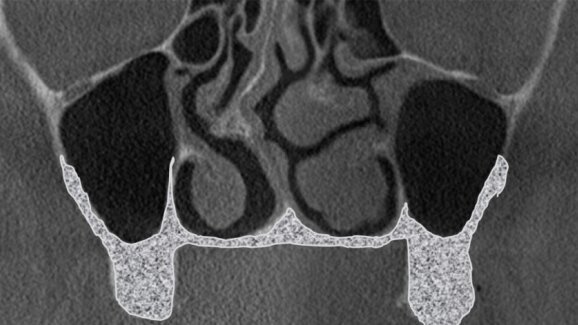 Podniesienie dna zatoki szczękowej z dostępu od strony podniebiennej jako metoda alternatywna