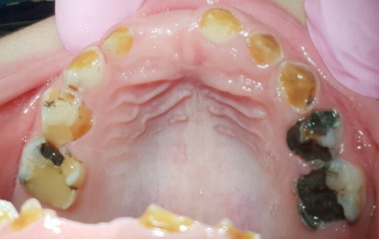 Afbeelding 4a: Kleurfoto’s op de leeftijd van 6 jaar, juli 2018. Alle cariëslaesies in de bovenkaak zijn arrested, in de 55, 64 en 65 met ondersteuning van SDF. Laesies die tijdens het aanbrengen arrested waren, zijn niet verkleurd.