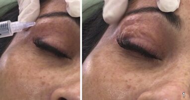 Ozonoterapia para revertir el envejecimiento facial