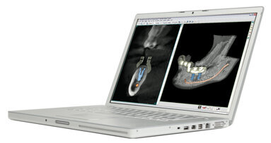 Materialise Dental unveils new software for implant treatment planning, plus online collaboration tool