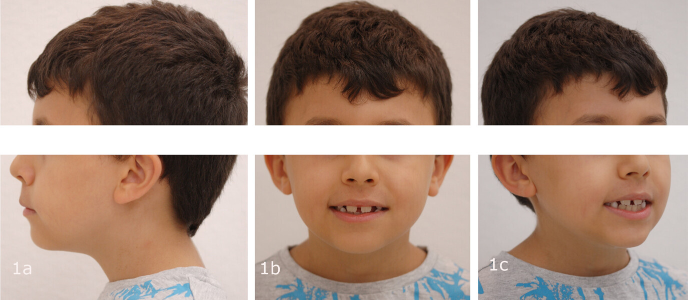 Figs. 1a–c: Extra-oral photographs at the start of treatment.