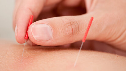 Nadeln gegen Würgereflex bei Abdrucknahme