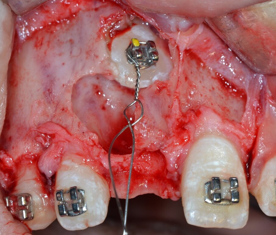 Fig. 17_Attacco ortodontico cementato e applicazione del mezzo di trazione.