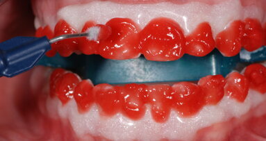 Los pros y los contras de los aclaramientos dentales