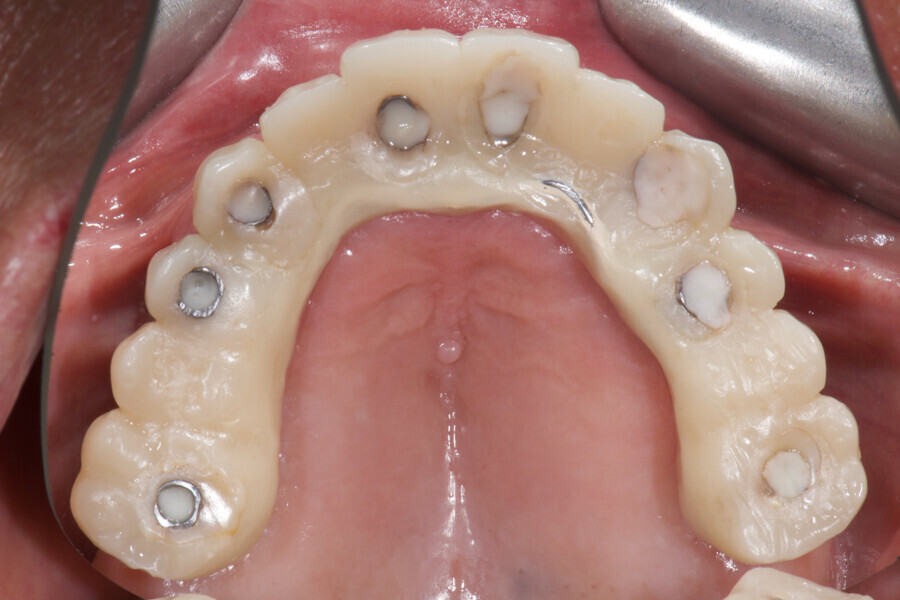 Fig. 12: Metal-reinforced temporary prosthesis in situ, occlusal view.