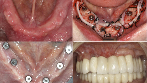 Nuevos métodos para obtener encía queratinizada alrededor de los implantes dentales