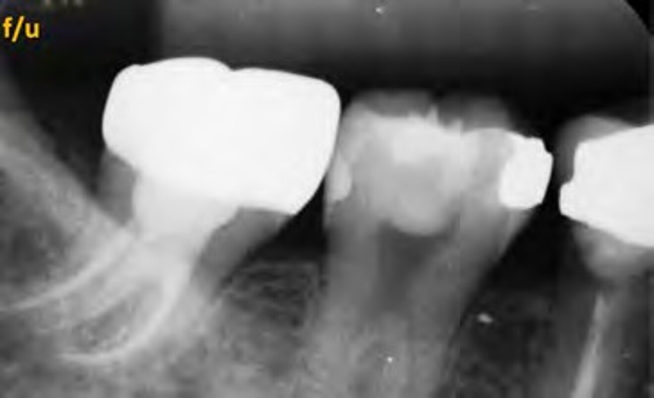 Fig. 2c: Eight-month follow-up  radiograph after crown placement demonstrating continued osseous healing and further reduction of the periradicular lesion. The tooth remained clinically asymptomatic.
