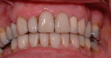 Porcelain Laminate Veneers – Avoiding Complications