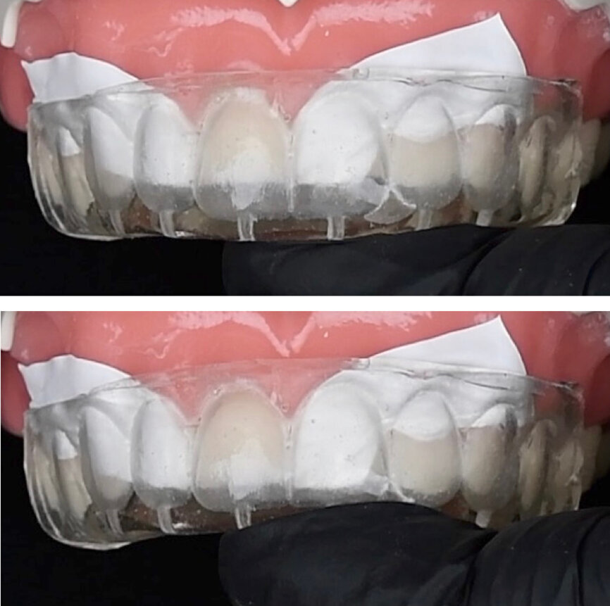 When using a silicone index in the flowable injection technique, the appearance of air bubbles can be avoided by ensuring that the index fits tightly to the tooth and is not moved during injection. (Image: Kuraray Noritake Dental) 